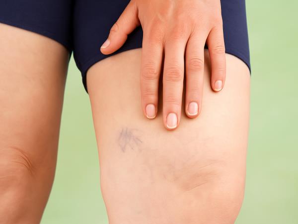 Pokajo vam žilice? To ni samo kozmetični problem – in vaš krožnik je morda del rešitve